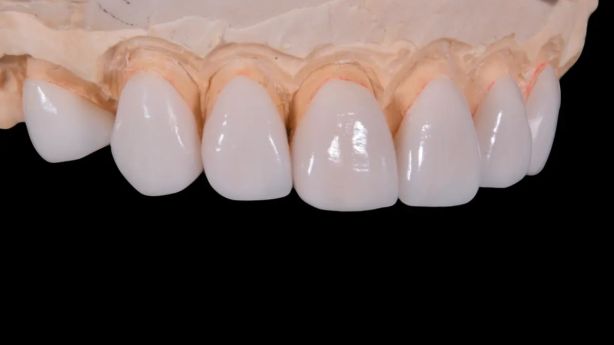 Row of lifelike ceramic crowns on a dental model
