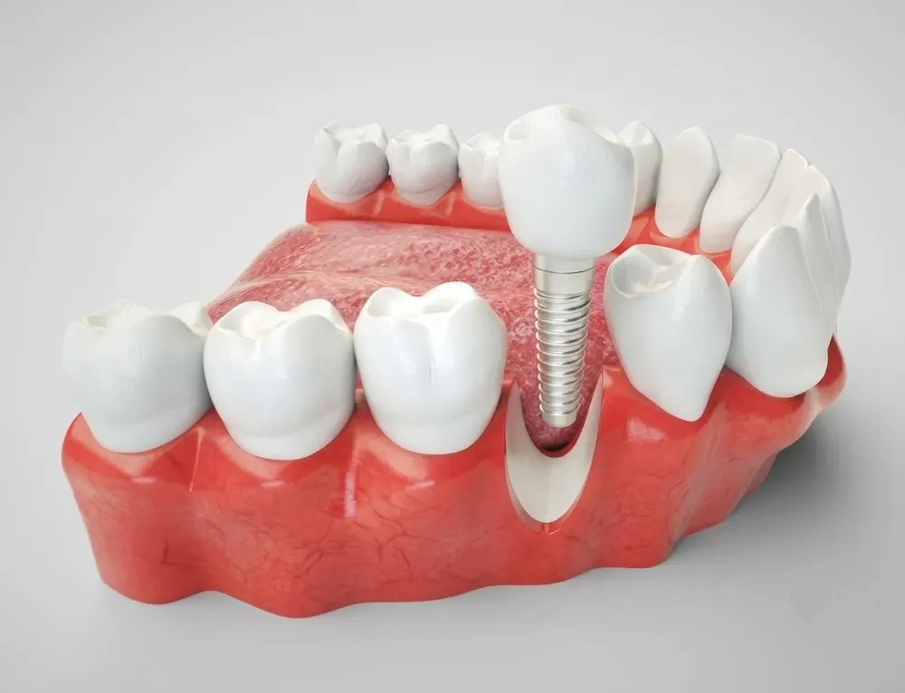 Model of an implant-supported crown on a dental implant